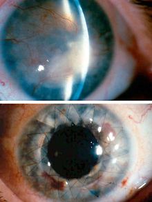 Eine Auge vor und nach einer herkömmlichen Hornhauttransplantation. 