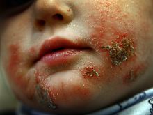 Neurodermitis trifft vor allem Kinder im ersten und zweiten Lebensjahr. 
