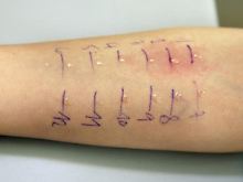 Mit einem Allergietest können Ärzte herausfinden, worauf das Immunsystem des Patienten reagiert. 