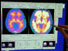 Mit moderner Technik kann Alzheimer-Patienten in den Kopf geschaut werden. 