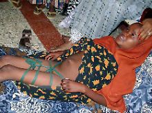 Dieses Mädchen liegt mit zusammengebundenen Beinen und auf einer Decke in Somalia. Es wurde vor fünf Tagen beschnitten. 
