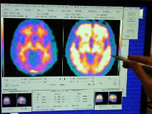 Die Alzheimer-Forschung arbeitet mit moderner bildgebender Technik.