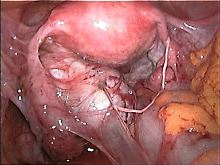 Massive Verwachsungen durch Endometriose. 