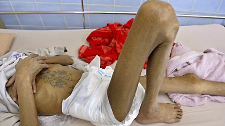 Die Zahl der AIDS-Kranken in Russland und der Ukraine ist alarmierend.