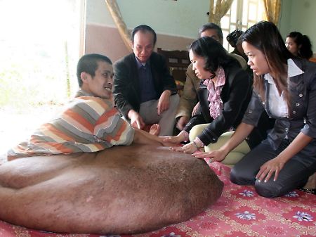Nguyen Duy Hai scheint froh zu sein, den riesigen Tumor endlich loszuwerden.