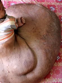 Die Entfernung des Tumors ist hochriskant.