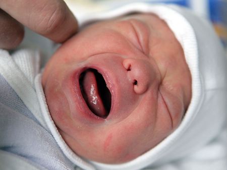 Neugeborene mit FASD haben oftmals heftige Entzugserscheinungen.