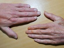 Die Hand eines Nichtrauchers und die Hand eines erkrankten Rauchers. 