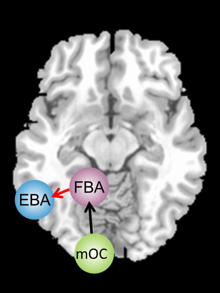 Körperbilder landen als visuelle Informationen zunächst im mittleren Okzipitallappen (mOC). Die „fusiform body area“ (FBA) und die „extrastriate body area“ (EBA) verarbeiten die Bilder anschließend weiter. Bei magersüchtigen Frauen ist die Verbindung vom Areal mOC zur FBA unbeeinträchtigt (schwarzer Pfeil). FBA und EBA arbeiten in der linken Hirnhälfte jedoch nicht normal zusammen (roter Pfeil).