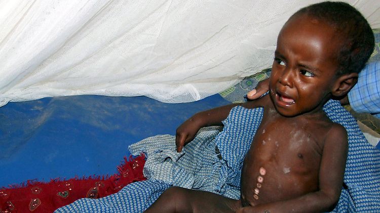 Nicht nur ein Mangel an Nährstoffen, sondern auch die Darmorganismen eines Kleinkindes können zur Entwicklung einer schweren Form von Mangelernährung beitragen. (Unterernährtes Kind in einem Krankenhaus in Somalia, Archivbild)