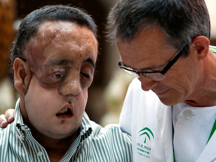 Zuletzt hatten Ärzte aus Spanien einem Patienten das gesamte Gesicht transplantiert.