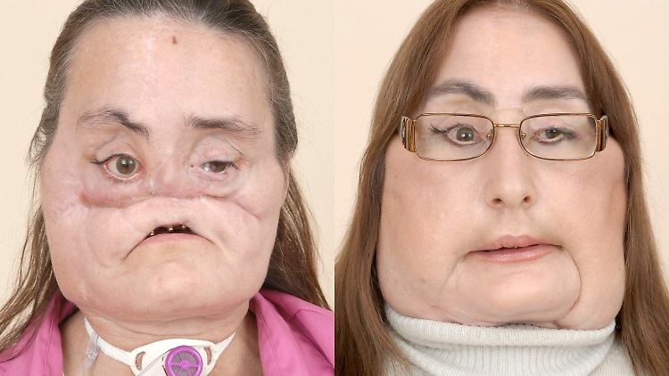 Die US-Amerikanerin Connie Culp bekam im Dezember 2008 ein neues Gesicht.
