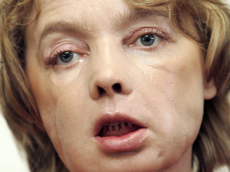 Isabelle Dinoire war die erste Patientin, die eine teilweise Gesichtstransplantation erhielt.