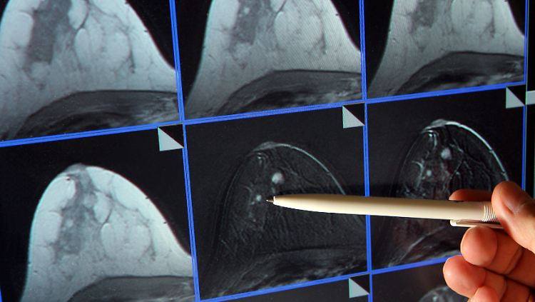 Krebs kann jeden treffen: Auf der Bildschirmdarstellung einer Magnetresonanz-(MR)-Mammographie ist ein winziger Tumor in der Brust einer Patientin zu sehen. 