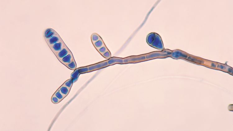 Der Pilz Fungus Exserohilum rostratum, mit dem ein Medikament in den USA  verunreinigt war, löste eine Meningitiswelle aus und forderte Ende 2012 mehr als zwei Dutzend Menschenleben.