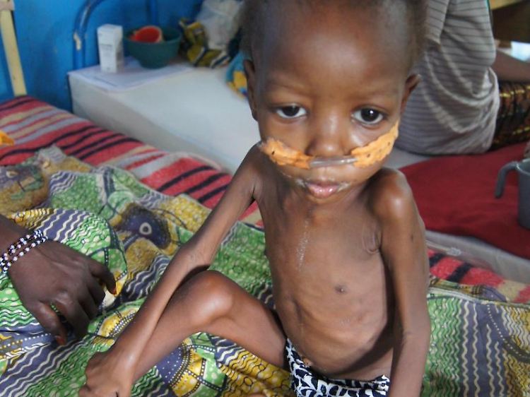 Ein unterernährtes Kind in einem Krankenhaus in Niger: Menschen, die in der Kindheit oft einen leeren Magen hatten, sind im Erwachsenenalter anfälliger für Krankheiten.