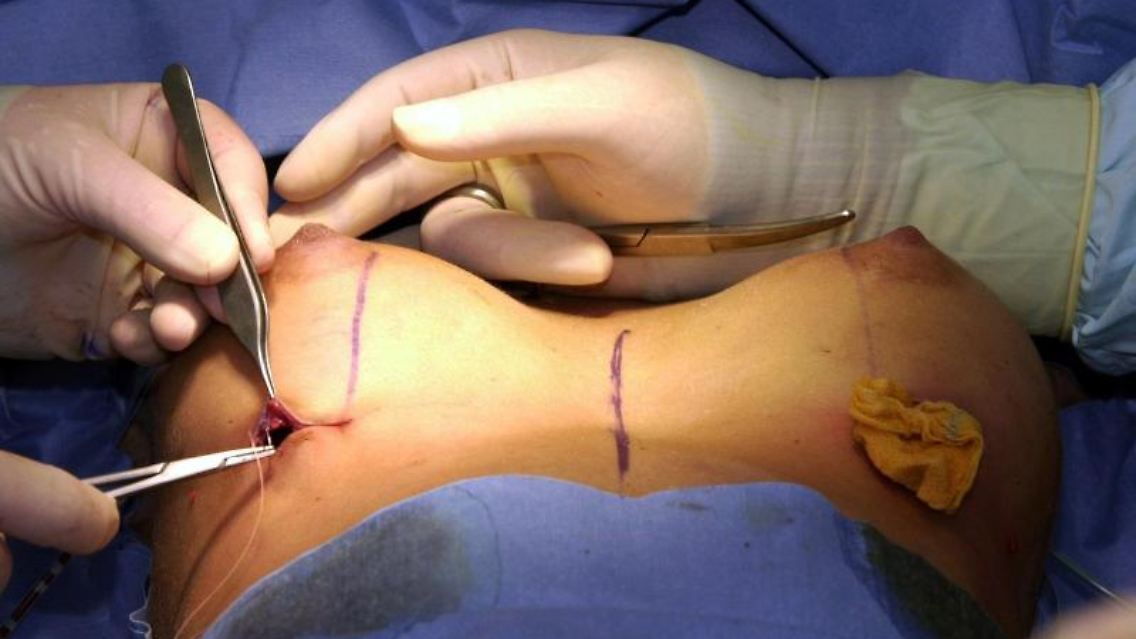 Bei einer Brustvergrößerung wird nach dem Einsetzen eines Silikon-Implantats der Schnitt zugenäht. Foto: Ulrich Perrey/Archiv.2013)