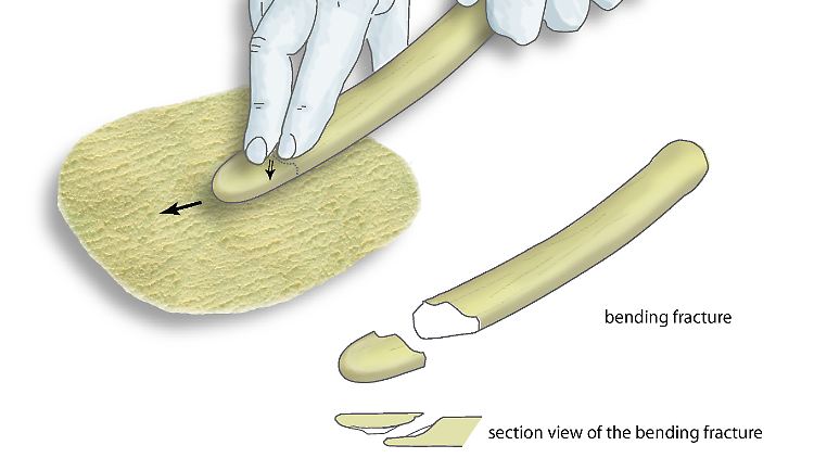 Die Grafik zeigt, wie die aus den Rippen von Rotwild hergestellten Lissoirs verwendet wurden, um Tierhäute geschmeidiger, glänzender und wasserbeständiger zu machen. Die natürliche Flexibilität der Rippen sorgt dabei für einen ständigen Druck auf die Tierhaut, ohne sie jedoch zu zerreißen. Im unteren Teil der Abbildung sieht man, wie der Abwärtsdruck schließlich zum Bruch führt, bei dem kleine Fragmente - ähnlich den drei gefundenen - entstehen.