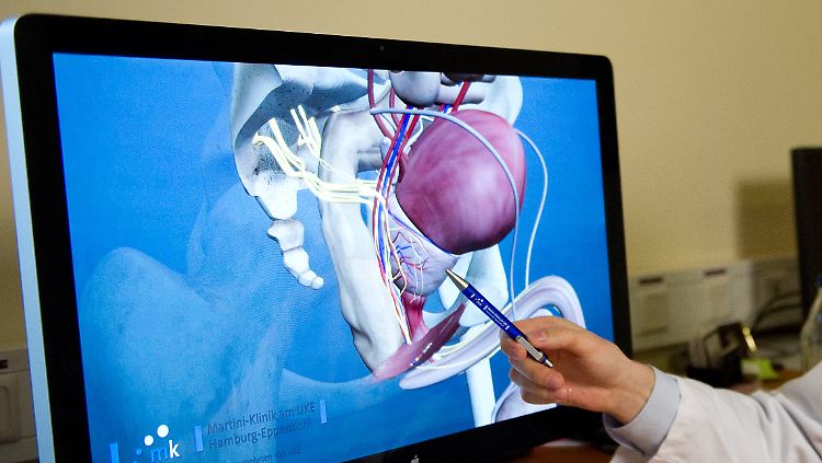 3D-Modell einer Prostata: Die üblichen Behandlungsmethoden können schädliche Nebenwirkungen wie Impotenz oder Inkontinenz haben.