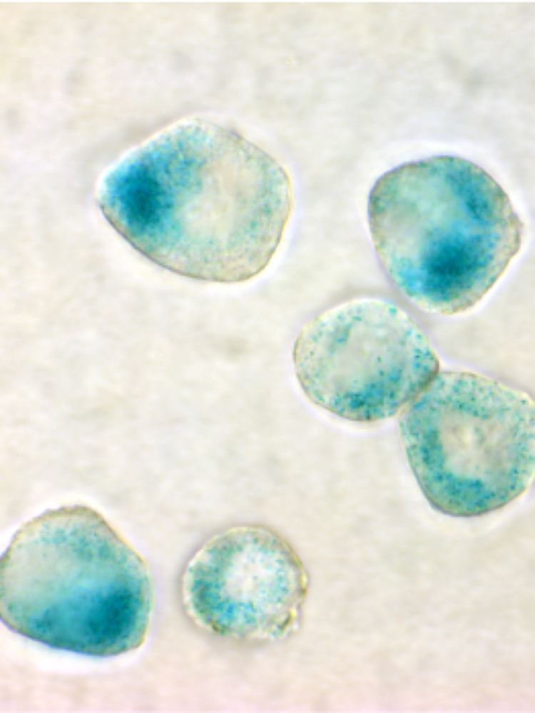 Seneszente Tumorzellen eines Lymphdrüsenkrebses nach Chemotherapie.