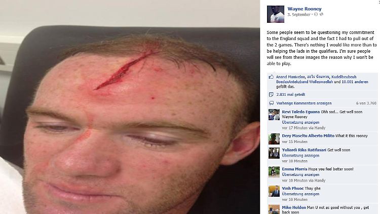 Gezeichnet: Wayne Rooney nach seinem Trainingsunfall.