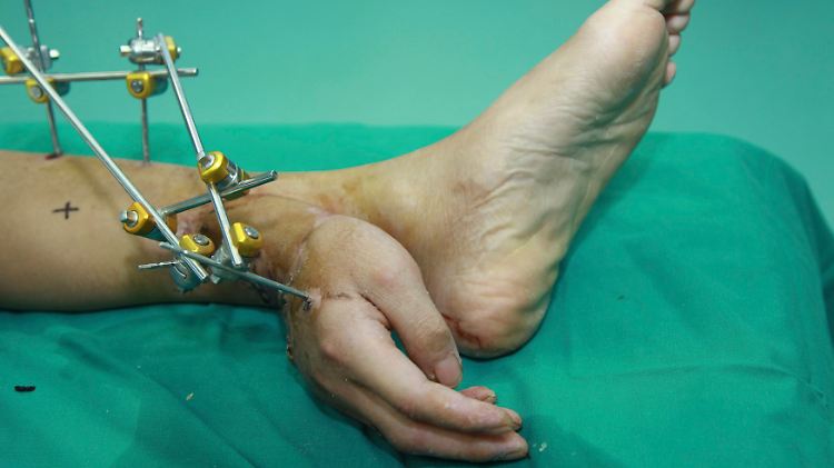 Die Hand war für einen Monat am Fuß des Patienten "geparkt".