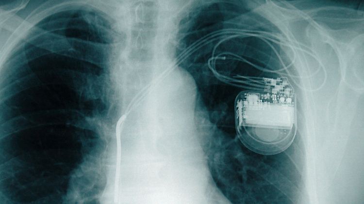 Bei den bisherigen Herzschrittmachern ist das Wechseln der Batterie mit Risiken verbunden.