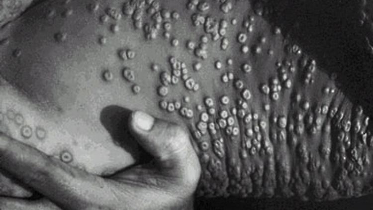 Das Variola-Virus greift zuerst die Schleimhäute von Nase oder Hals an und breitet sich dann im Körper aus. Auf der Haut entsteht ein typischer Ausschlag, gefolgt von Bläschen und Pusteln.
