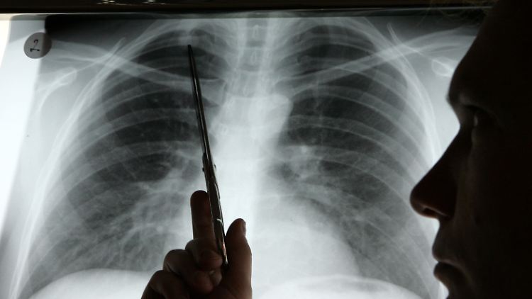 Die Einnahme von Antioxidantien zur Prävention von Lungenkrebs könnte einen gegenteiligen Effekt haben.