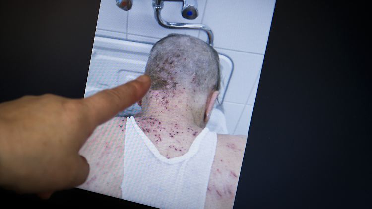 Die Obdachlosen-Ärztin Jenny De la Torre zeigt in ihrer Praxis ein Foto von einem Patienten, der von Krätze befallen ist. Die Krätze (Skabies) ist in ihrer Praxis Alltag.