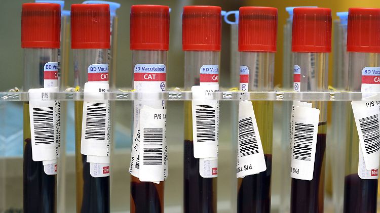 Nach über 500 Bluttests gelang der Wissenschaft ein Durchbruch in der Alzheimer-Forschung.