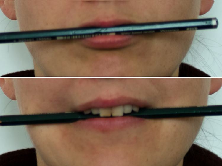Beim Halten eines Stiftes zwischen den Lippen wird der Ringmuskel um den Mund aktiviert (oben), beim Halten des Stiftes mit den Zähnen der Jochbeinmuskel.