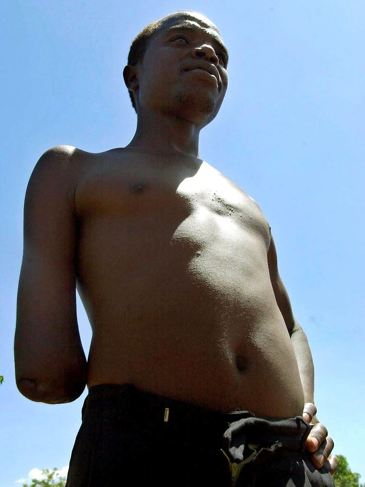 Auch Richard Masinde wurde am Lake Victoria von einem Krokodil angegriffen. Er verlor seinen rechten Unterarm.