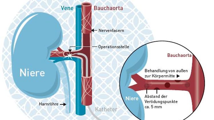 Darstellung einer renalen Denervation.
