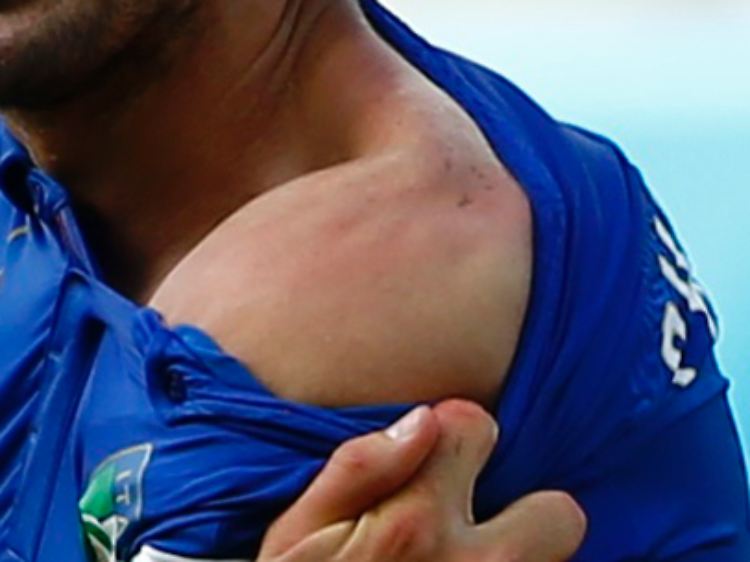 Deutlich zu sehen: Die Bissspuren, die Suárez' Attacke bei Giorgio Chiellini hinterlassen haben.