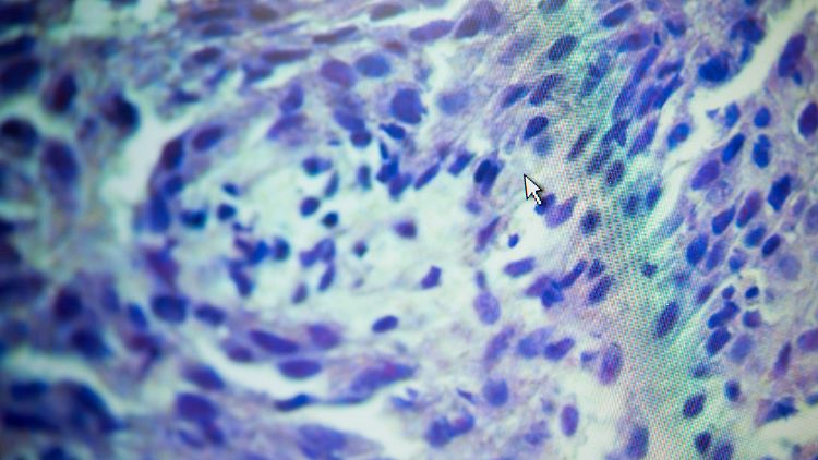 Die mikroskopische Aufnahme zeigt Tumorgewebe, das im Pathologischen Institut des Klinikums Dortmund untersucht wurde.