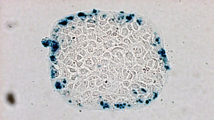 Auch Krebszellen werden bisher nach ihrem Ursprung klassifiziert. Im Bild: Darmkrebszellen mit injizierten, genetisch veränderten E.coli-Bakterien.