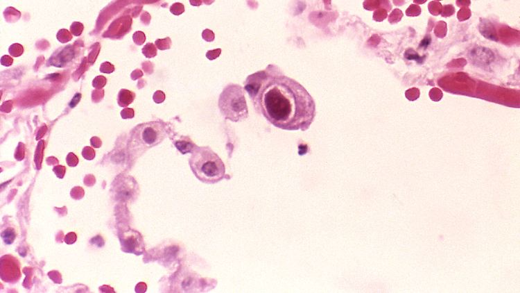 So sieht eine Infektion mit HCMV der Lunge unter dem Mikroskop aus.
