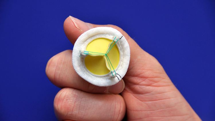 Die Magna Mitral Ease stammt vom größten Anbieter von Herzklappen dem US-amerikanischen Unternehmen Edwards Lifesciences.