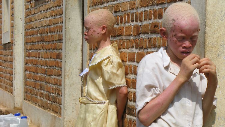 Albinos sind in Tansania gefährdet, da ihren Körperteilen und Organen magische Kräfte nachgesagt werden.