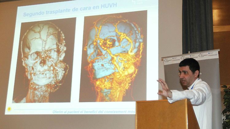 Bei dem Eingriff erhielt der Patient ein Transplantat für zwei Drittel der unteren Gesichtshälfte, den Hals, den Mund, die Zunge und den Rachen.