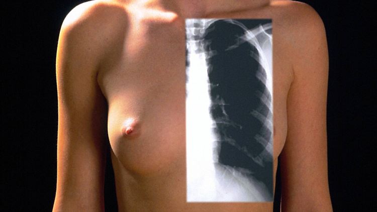 COPD hebt langsam die Funktion der Lunge auf.
