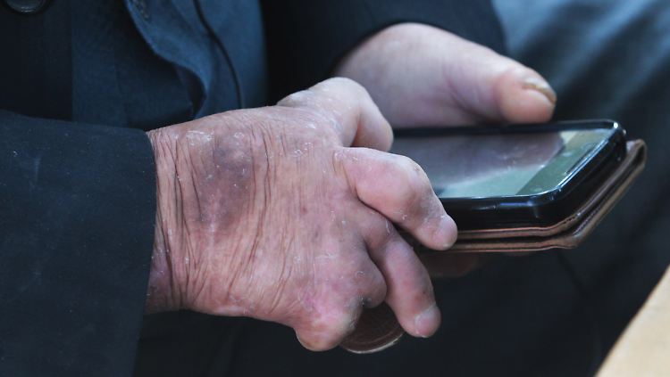 Lepra gilt als heilbar, aber die notwendigen Medikamente stehen nicht in allen Ländern ausreichend zur Verfügung.