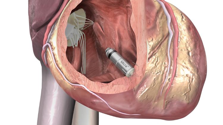 Die Darstellung zeigt die implantierte Kardiokapsel.