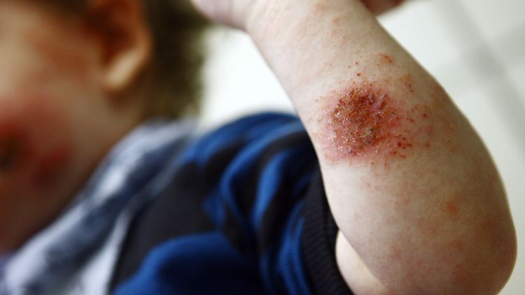 Ein Kinderarm mit Neurodermitis.