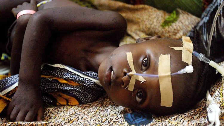 Kampf gegen Krankheiten und Hunger: Ein unterernährtes Kind in Monrovia.