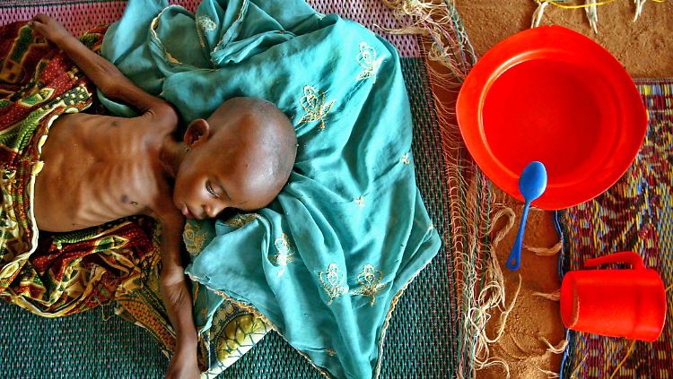 Ein unterernährtes Kind liegt in einem Therapiezentrum der Organisation Ärzte ohne Grenzen im nigerischen Maradi.