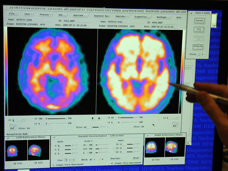 Mit moderner Technik kann Alzheimer-Patienten in den Kopf geschaut werden.