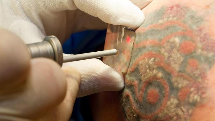 Um ein Tattoo zu entfernen, werden heute in der Regel Laser benutzt. Lichtsignale zerkleinern die Farbpigmente in der Haut. Diese können dann über die Lymphe abtransportiert werden.