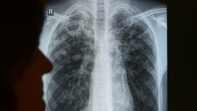 Tuberkulose-Erreger befallen am häufigsten die Lunge. 2013 starben weltweit 1,5 Millionen Menschen an den Folgen von Tuberkulose.